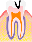 中度のむし歯