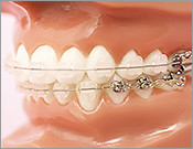 Adult orthodontics