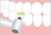 歯と歯肉縁下の汚れをラテックスゴムのカップやブラシで落とします