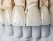 ジルコニアクラウン（前歯部用色付け仕上げ）