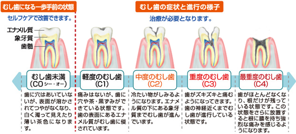 むし歯の進行