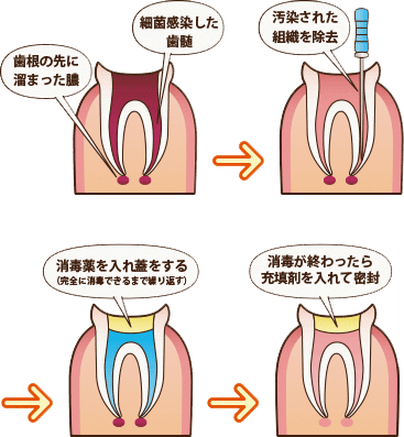 根管治療の流れ