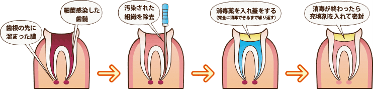 根管治療の流れ