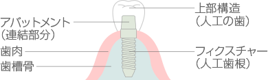 インプラントの構造
