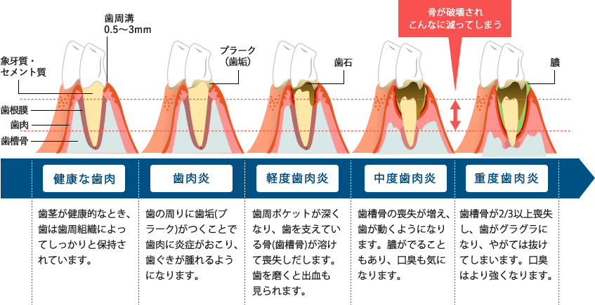 歯周病の進行