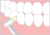 歯と歯の隣接面の汚れをプラスチックのチップでこすり落とします